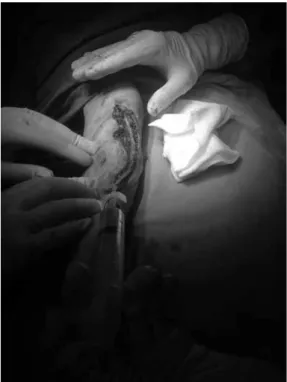 Figure 1. Harvesting basilic vein in forearm using a  single incision from elbow joint to wrist.