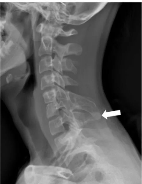 Figure 1. C5 vertebral spinous process hypertrophy  on lateral AP radiograph (white arrow).