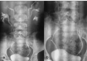 Figure 1. Intravenous Pyelography of the patient. 1-A: Left  ureteral triplication with right ureter duplication and  dila-ted lower pole of right kidney
