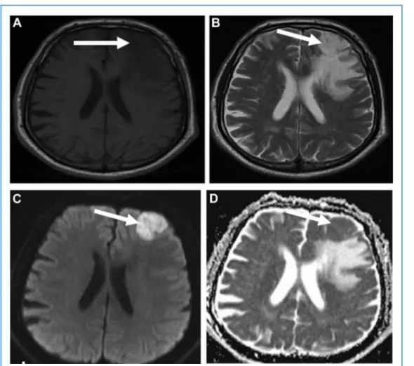 Figure 1. Axial T1-weighted ( A) and axial T2-weighted ( B) images show an extraaxial mass and parenchymal edema (arrows)