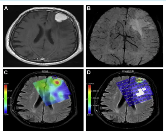 Figure 2. Contrast-enhanced axial T1-weighted image (A) shows diffuse homogeneous contrast