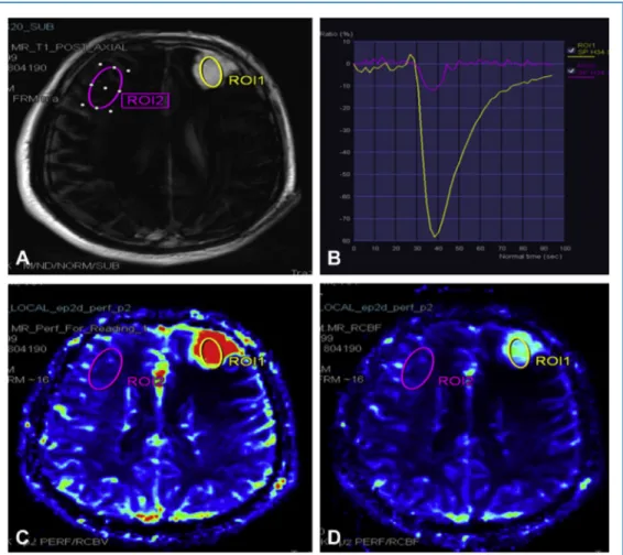 Figure 3. Perfusion graphics did not show T1-dominant contrast leakage pattern on perfusion magnetic resonance imaging examination, which is typically seen