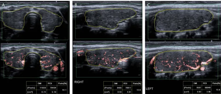 FIGURE 3. A 10-year-old symptomatic woman with HT. Quantitative 2DcSMIVI values were measured by manually drawing the contours of the thyroid gland structure, with free ROI, on the cSMI mode, in the longest left lobe longitudinal plane, and a 5-second imag
