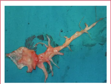 Fig. 2.  The pulmonary thromboendarterectomy material that  was removed from the right pulmonary artery.