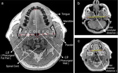 Fig. 2 Craniofacial landmarks: ANS, anterior nasal spine; PNS, posterior nasal spine; N, nasion; S, sella; H, most anterior point of the hyoid bone;