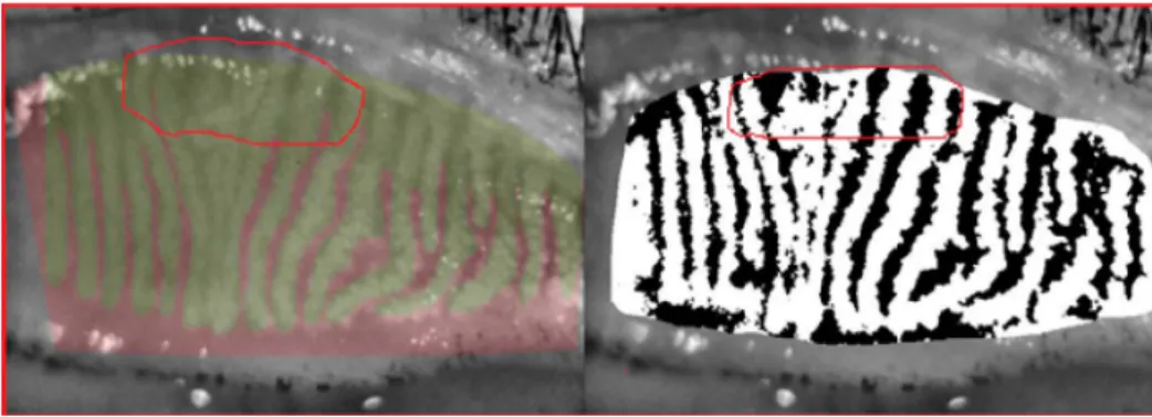 FIGURE 4. Semi-automated meibo- meibo-mian gland detector detects light reflections as MG areas