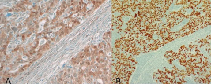 Figure 3. A) Benign omentum without NNMT immunoreactivity (original magnification 200×)
