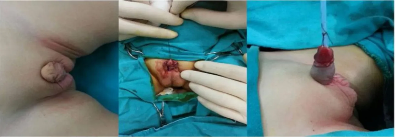 Figure 1. Flapping and tubularization in technic, The urethral plate was preserved and the ventral curvature was corrected.