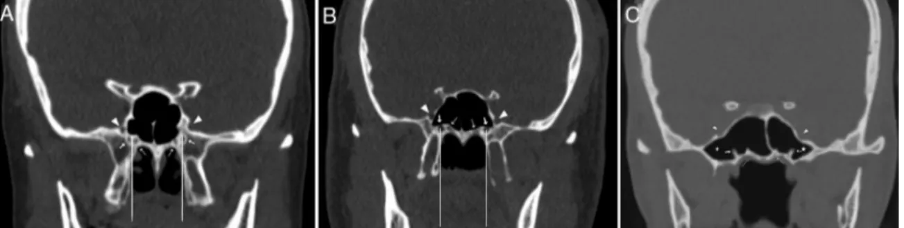 Figure 1 Coronal CT sections showing the vidian canal (thick arrow), palatovaginal canal (thin arrow), foramen rotundum (arrow- (arrow-head), pterygoid recess pneumatization (star)