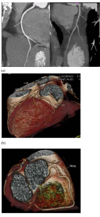 Şekil 1. a, MIP ve b,c VRT görüntülerde normal  koroner damarlar görülüyor (RCA; sağ koroner  arter LAD; sol inen koroner arter CX; sirkumfleks  arter) 
