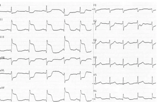 Fig. 1. Inferolateral (with posterior wall) myocardial infarction with terminal QRS distortion (G3I+) (J points emerge at ≥50% of the R wave amplitude in leads II, III and aVF).