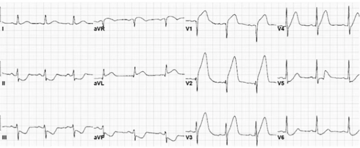 Fig. 2. Anteroseptal myocardial infarction without terminal QRS distortion (G3I−) (S wave persists in leads V1, V2 and V3).