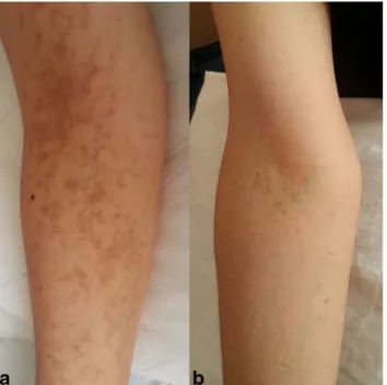 Fig. 2 Hyperpigmented areas were located on the forearm of his mother and grandmother