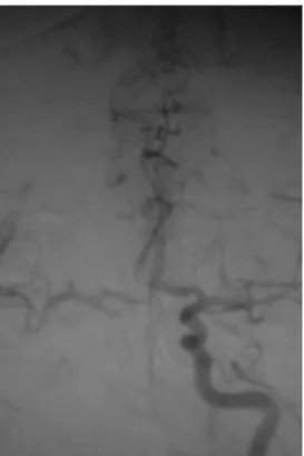 Figure 1.  Stenosis is observed in the proximal left common carotid  artery following contrast agent administration through 7-F guiding  catheter in the right brachial artery