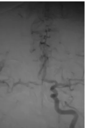 Figure 1.  Stenosis is observed in the proximal left common carotid  artery following contrast agent administration through 7-F guiding  catheter in the right brachial artery