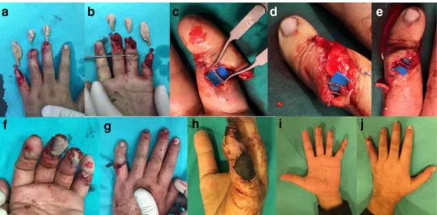 Fig. 2 a 20-year-old female worker sustained to a right thumb skin only amputation by a roller, right hand skin only amputation through MPJ
