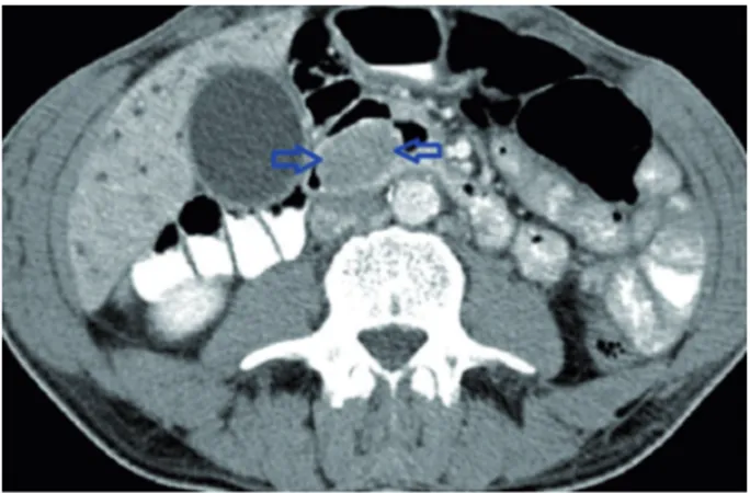 Figure 2. Axial contrast-enhanced computed tomography demonstrates  bile duct calculi with a density of 72 HU