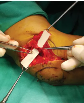 Fig. 1 Intraoperative view shows the piece of glass inside the cubital tunnel and the laceration of the ulnar nerve.
