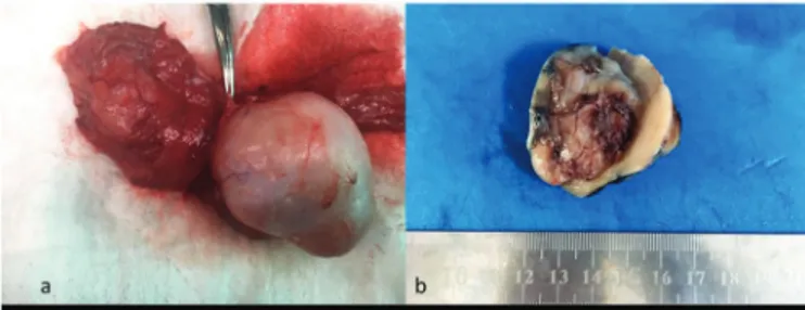 Figure 1.  The  gross  specimen  revealed  dirty-white  firm  mass  with  some  hemorhage and degeneration areas on the cut section