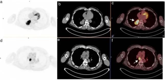Fig. 1. Transaxial PET (a), CT (b), and fused (c) images of 68 year old male patient showed a primary tumor in the lower lobe of the right lung with a longest diameter of 61 mm, which was diagnosed as squamous cell carcinoma (arrow, c) In the transaxial PE
