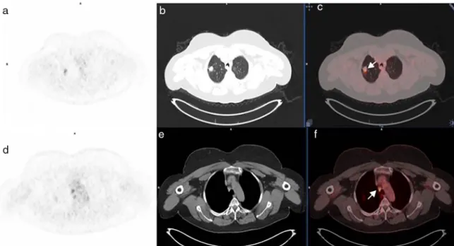 Fig. 3. Transaxial PET (a), CT (b), and fused (c) images of a 68 year old female patient depicted the primary tumor in the upper lobe of the right lung (arrow, c)