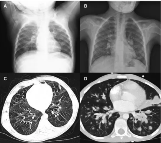 FIG E1. Anteroposterior chest radiography showing lack of thymic shadow in P2 (A) and P3 (B) and noncon- noncon-trast chest CT scan showing bronchiectasis in P2 (C) and multiple parenchymal nodules in P3 (D).