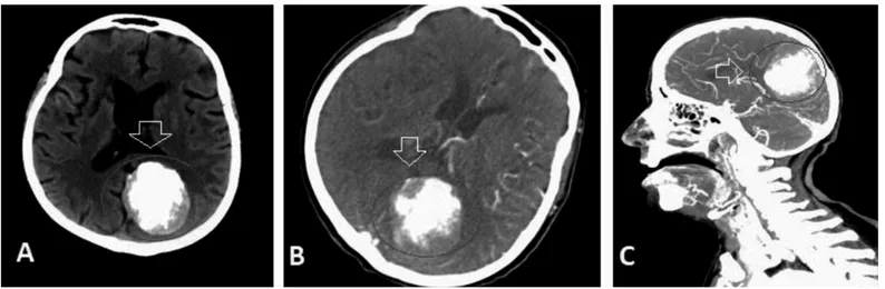 Figure 1.  A) Brain tomography (before intravenous gadolinium injection). B) Brain tomography (after intravenous gadolinium injection)