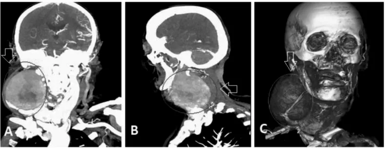 Figure 2.  Cervical tomography angiography; A) coronal; B) sagittal; C) 3D-coronal: thrombotic aneurysm (9x9.7 cm) in the right cervical area