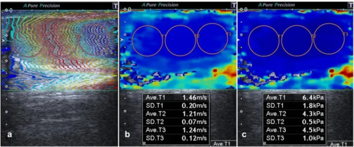 Fig. 1    The testis of a 29-year-old patient with infertility. After freez- freez-ing, SWE images were viewed using three display modes:  propaga-tion mode (a), speed mode (m/s) (b), and elasticity mode (kPa) (c)