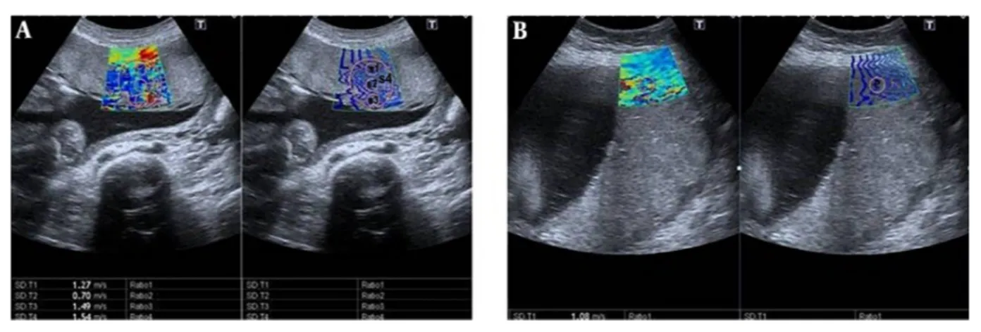 Figure 1. Shear wave elastography (SWE) images of the placenta in pregnant women. Two split shear wave elastography images are at the same level