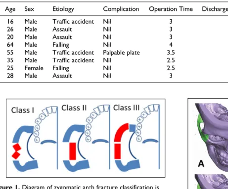 Figure 1. Diagram of zygomatic arch fracture classification is according to the zygomatic arch classification of Ho¨nig et al.