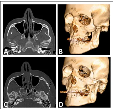 Figure 4. A, Case 2 in table: Class I zygomatic arch fracture on the left side can be seen on axial section of computed tomography