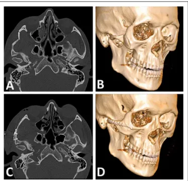 Figure 6. A, The fracture line is visualized without additional materials and extensive dissection