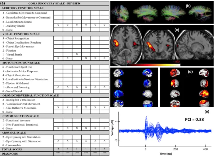 Figure 2 Case example: a 27-year-old woman with a history of focal epilepsy was admitted with headache, confusion and rapid loss of consciousness due to an intracranial hemorrhage from a right parietal arteriovenous malformation