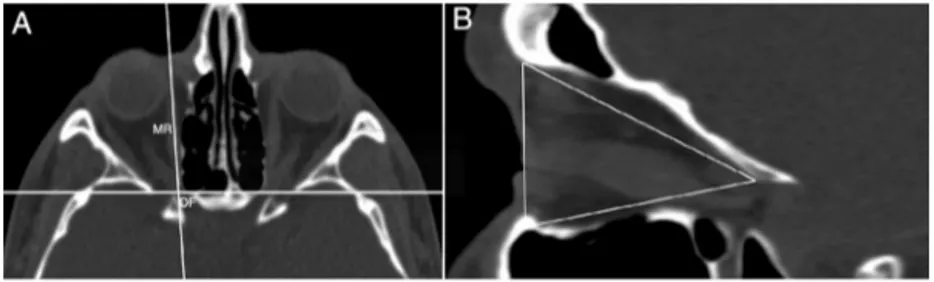 Figure 4 (A) Axial image shows identiﬁcation of the orbital foramen (OF) and medial rectus muscle (MR)