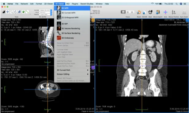 Şekil 3.1. 3D MPR ile Sagital, Transvers ve Coronal Görüntü Serileri. 