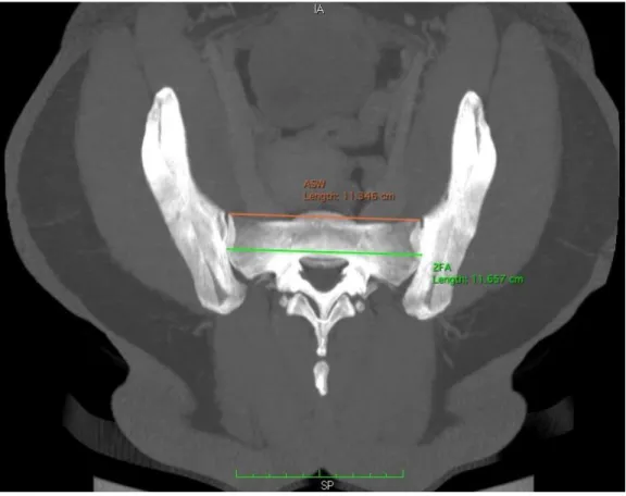 Şekil 3.7. İki facies auricularis arasındaki uzaklık (2FA-S) ve anterior sakral  genişliğin (ASW) ölçümleri