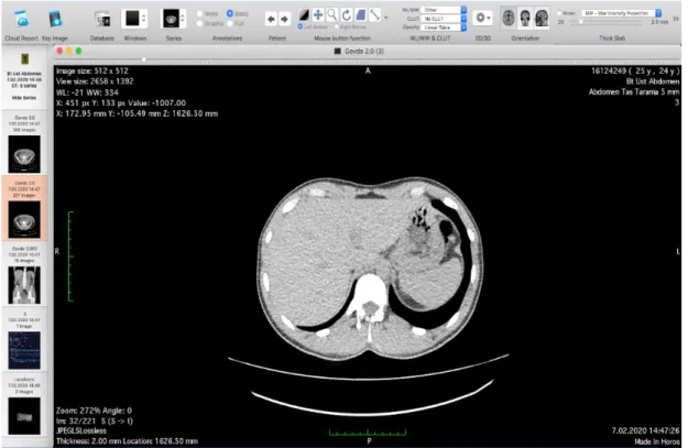Şekil 9. Horos Project programı kullanarak dicom dosyalarının görüntülenmesi. 