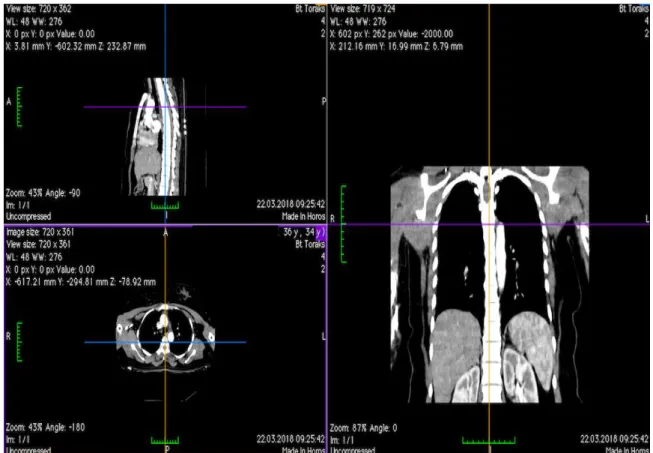 ġekil 6. Verilerin Horos Medical Viewer programına aktarımı. 