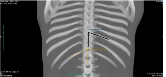 ġekil 9. Horos Medical Viewer programının sahip olduğu ölçüm araçları kullanılarak  yapılan açı ölçümü