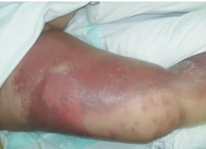 Figure 1. The erythematous, indurated soft tissue lesion  on the right thigh.