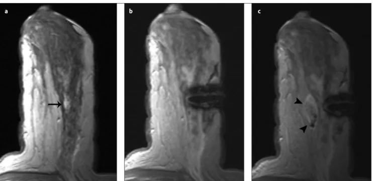 Figure 2. a-c.  Core-needle  biopsy  of  a  lesion  in  the  left  breast  of  a  42-year-old  woman  (a)  A  12mm  in  diameter,  non-mass  contrast  enhancement in the middle outer section of the left breast on axial contrast-enhanced T1-weighted image (
