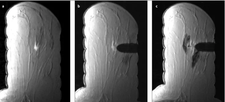 Figure 3. a-c. Vacuum-assisted biopsy for a lesion of the left breast in a 54-year-old woman (a) The view of an irregular bordered, round,  nodular lesion 5 mm in diameter on contrast-enhanced T1-weighted axial image of the left breast (b) Image of the les