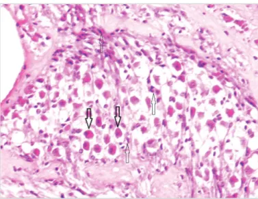 Figure 3. Mild edema and degeneration of ganglion cells. Thick  arrow: Normal ganglion cells, thin arrow: degenerated ganglion cells  (H&amp;E, 400×)