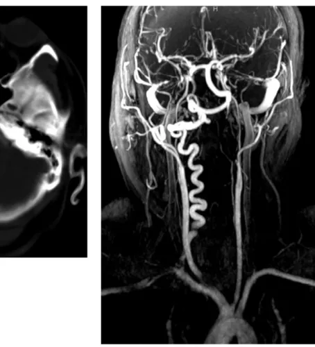 Figure 2. (a) Coronal reformat computed tomography image demonstrates diffuse tracheobronchial thickening and left main  bronchus narrowing