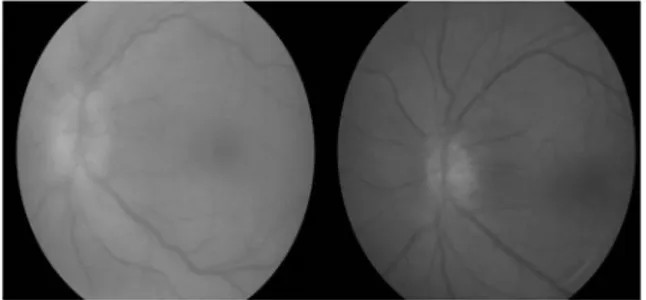 Figure 2. Posterior pole image of the patient at presentation (A)  with signs of papilledema and tortuous vessels due to high  in-traocular pressure and 1 week after (B) the signs of the herpetic  attack have subsided.