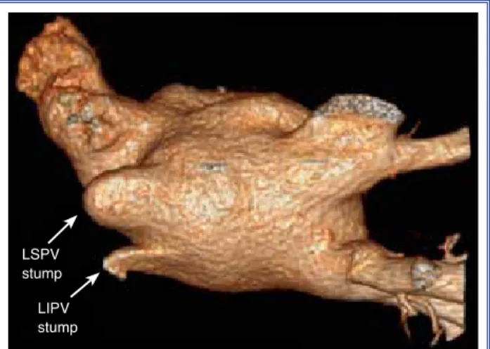 Figure 1. Three-dimensional reconstruction of the left atri- atri-um and pulmonary veins in posterior-superior view