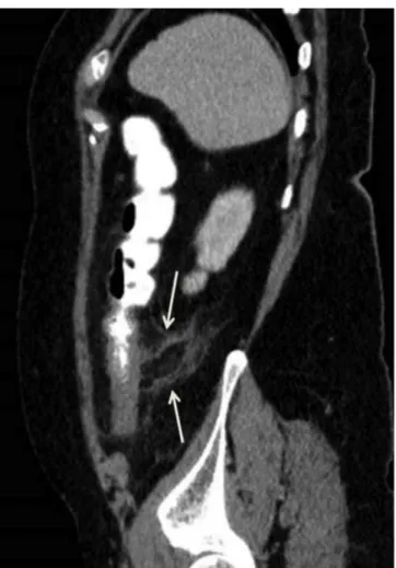 Figure 1. An oval lesion (arrow) with an impression of peripheral rim which ap- ap-pears hypodense due to central fat density and hyperdense due to serosal  inflam-mation is seen which suggests the presence of epiploic appendigitis in the  poste-rior of th