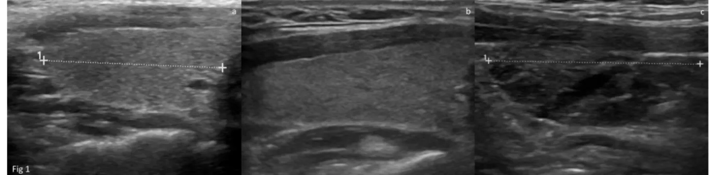 Figure 1. a) Normal sonographic findings from group 1 (control group), b) group 2 (early stage/indeterminate cases) exhibits normal  glandular vascularization (not shown here) and laboratory data, with very slight parenchymal heterogeneity, c) group 3 (def