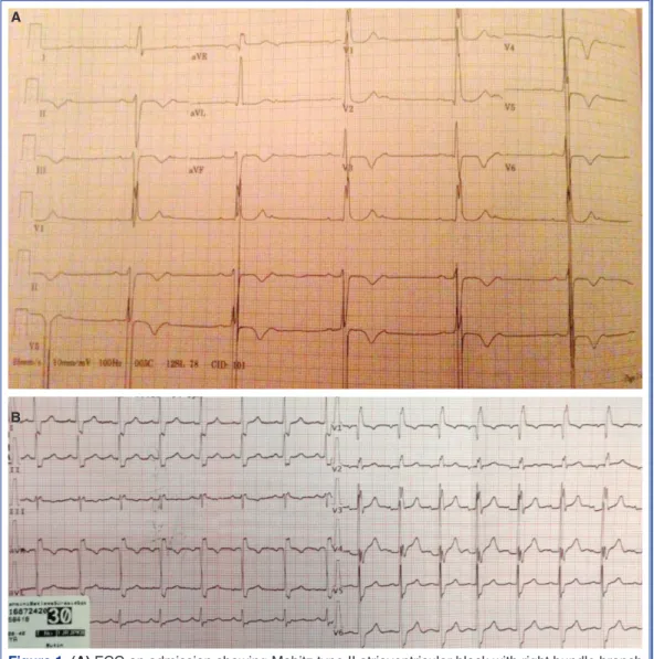 Figure 1. (A) ECG on admission showing Mobitz type II atrioventricular block with right bundle branch  block, left anterior hemiblock, and T-wave inversions in leads V4 through V6